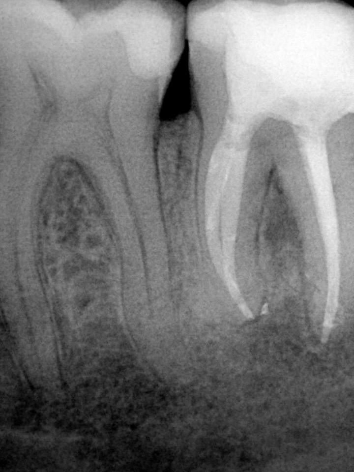 Pēc endodontiskās ārstēšanas