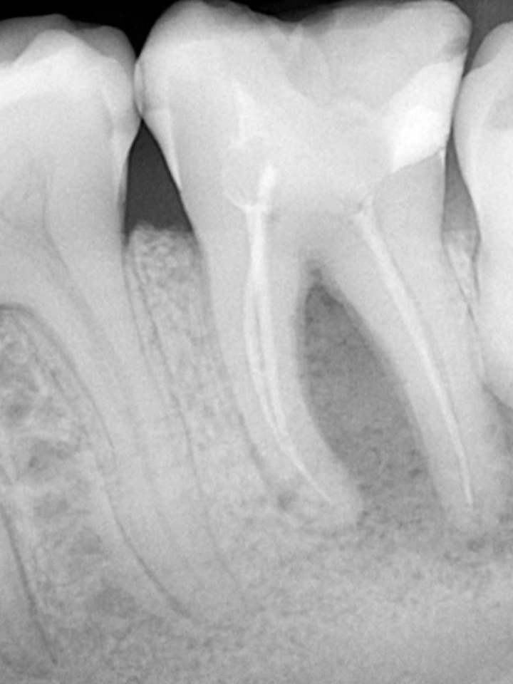 Pirms endodontiskās ārstēšanas